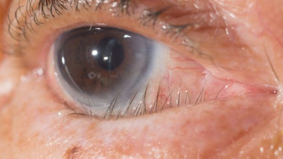 trikiasis