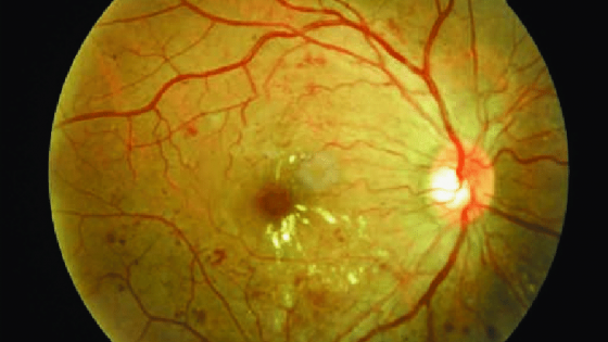 Typical-image-of-nonproliferative-diabetic-retinopathy-with-clinically-significant