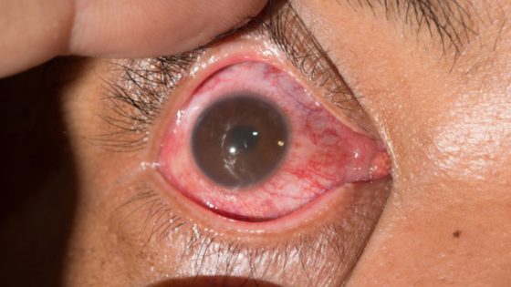 Uveitis (mata merah)