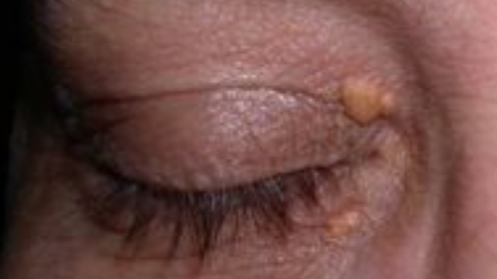 Xanthelasma