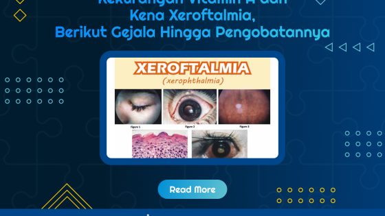 Xeroftalmia