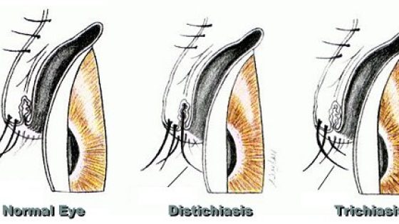 distrikiasis