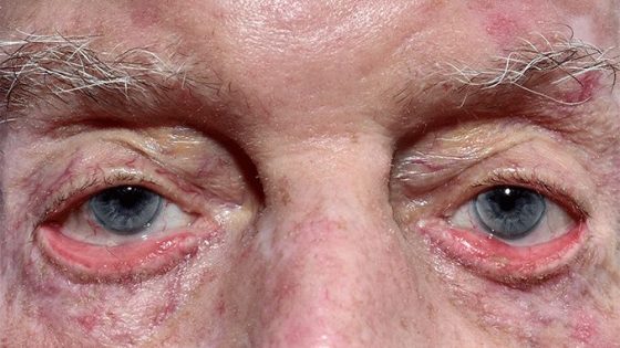 Ektropion mata mengendur pada lansia