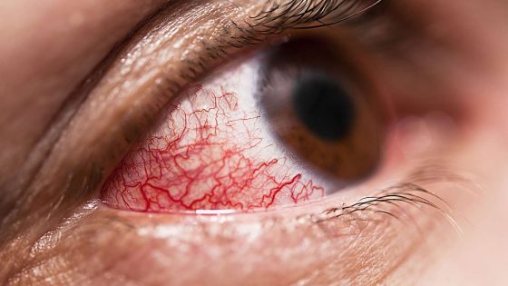 episkleritis