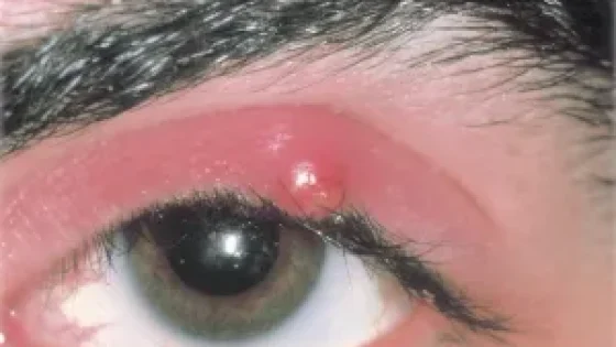 mata bintitan sembuh sendiri.