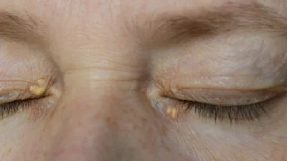 xanthelasma dan milia