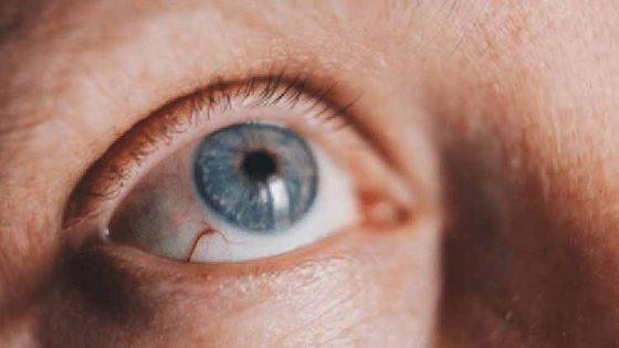 Keratitis