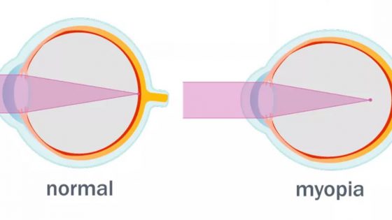 Perbedaan mata minus dan mata normal