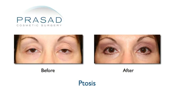 operasi ptosis.