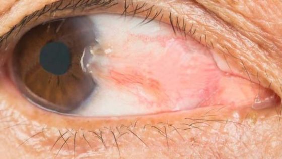 Pterygium seperti daging tumbuh di Kornea