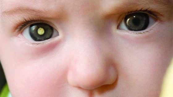 Retinoblastoma