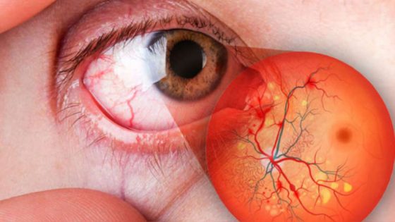 retinopati diabetik
