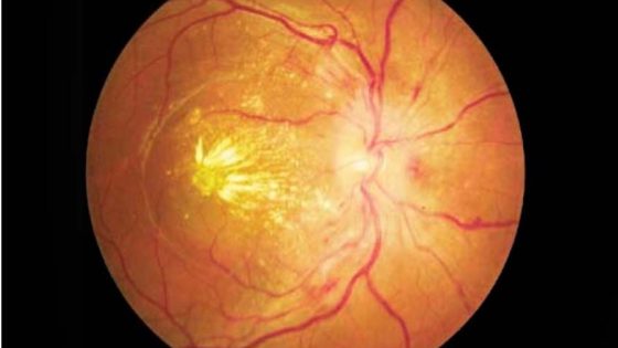 retina dengan kondisi Retinopati Hipertensi