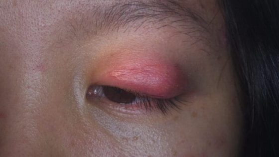 Selulitis Orbital
