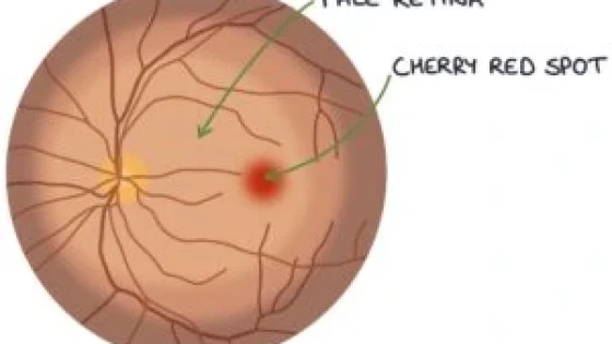 central retinal artery occlusion
