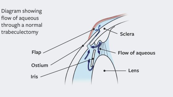 trabekulektomi