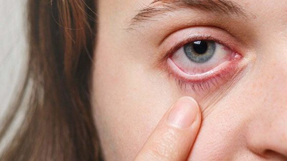 konjunghtivitis vernal